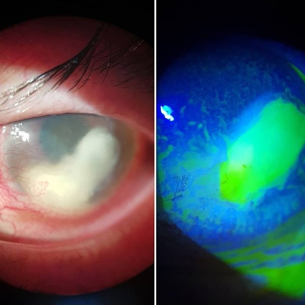 Úlcera corneal bacteriana complicada
