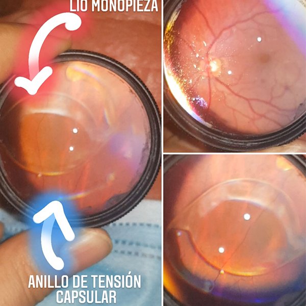 luxación espontánea de lio y anillo de tensión capsular