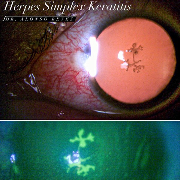 Herpes simplex keratitis