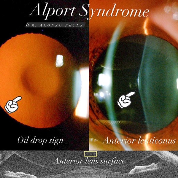 Anterior Lenticonus due Alport Syndrome