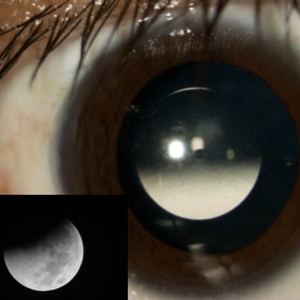 Eclipse Parcial