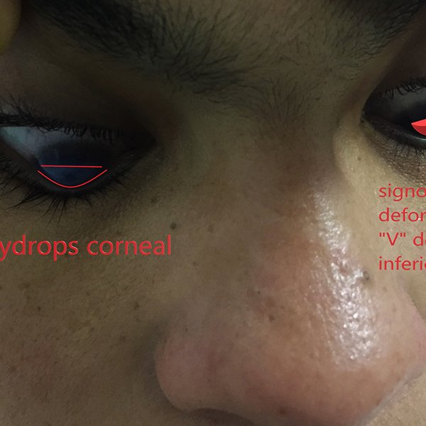 Hydrops y Signo de Mutson