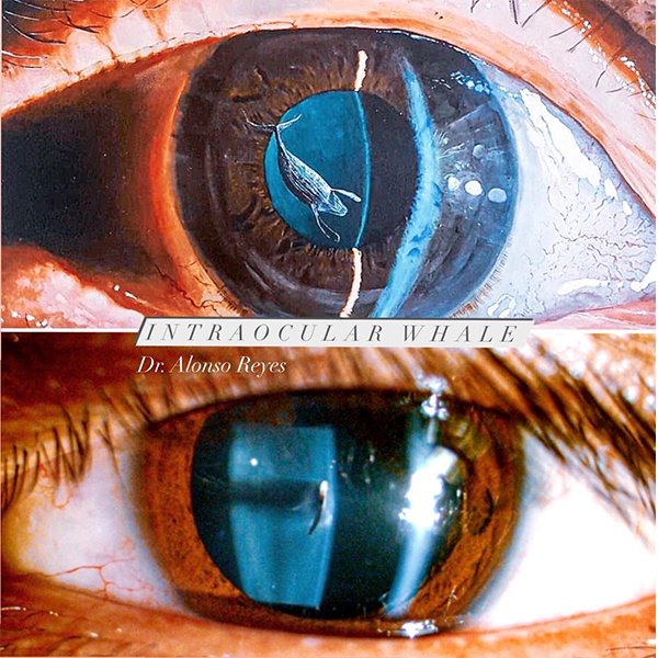 Intraocular Whale