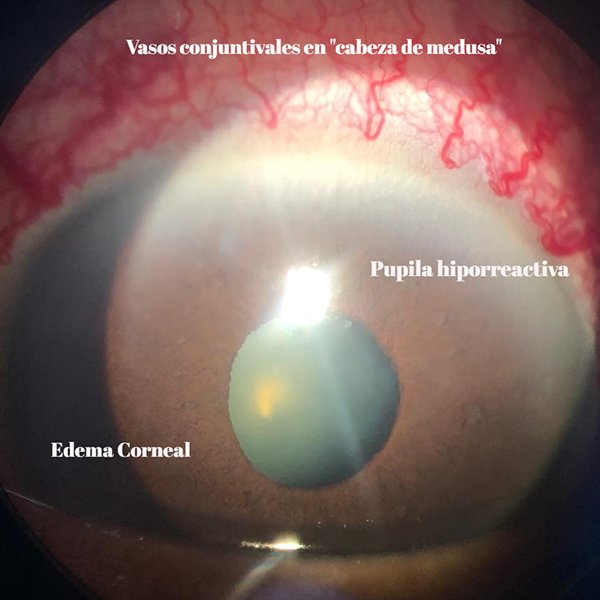 Fistula Carotidocavernosa