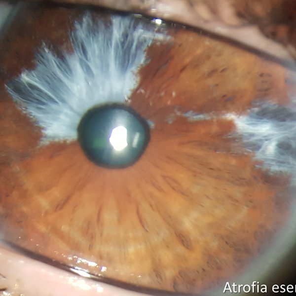 Atrofia esencial de iris