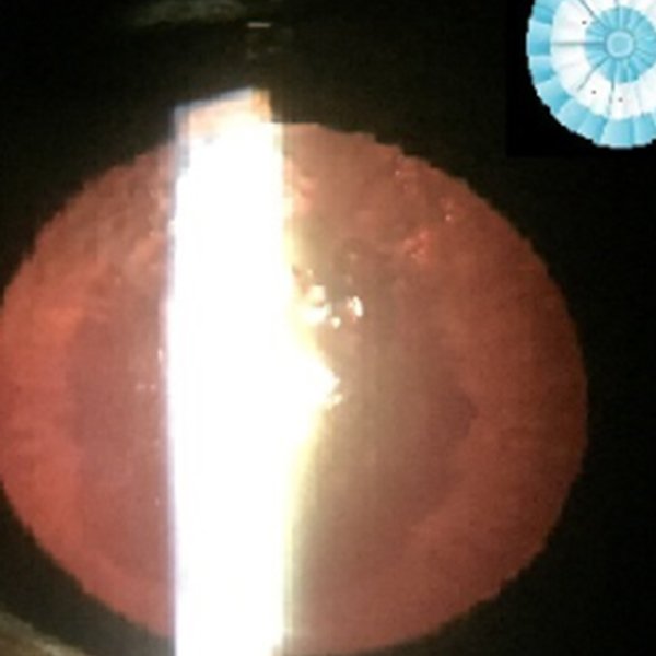 Glaucoma patrio