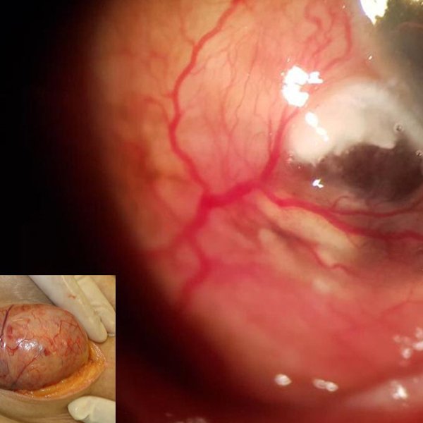 Perforacion escleral