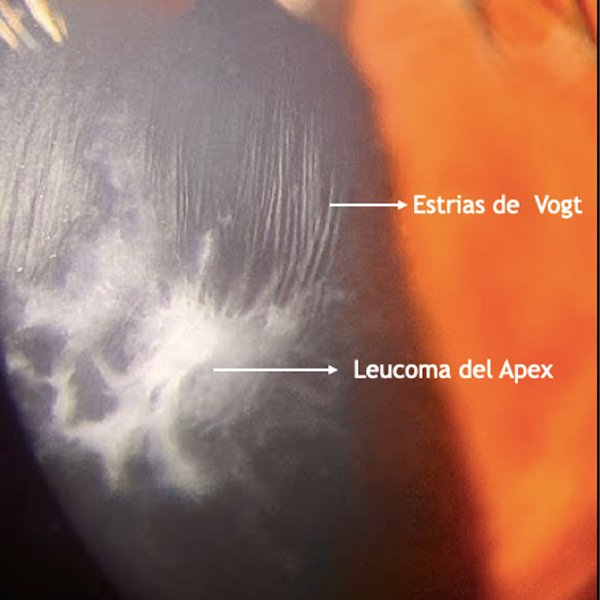 Queratocono Avanzado