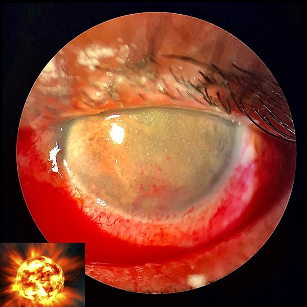 Eye Supernova