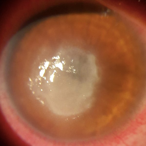 Queratitis por Acanthamoeba