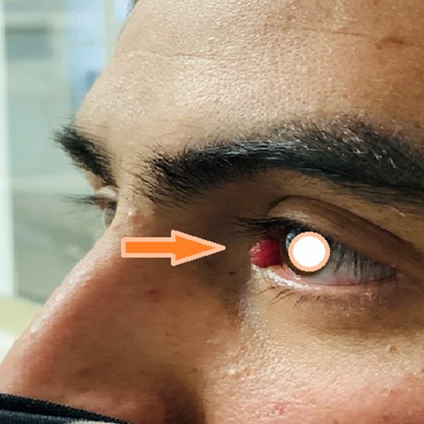 papiloma conjuntival en caruncula