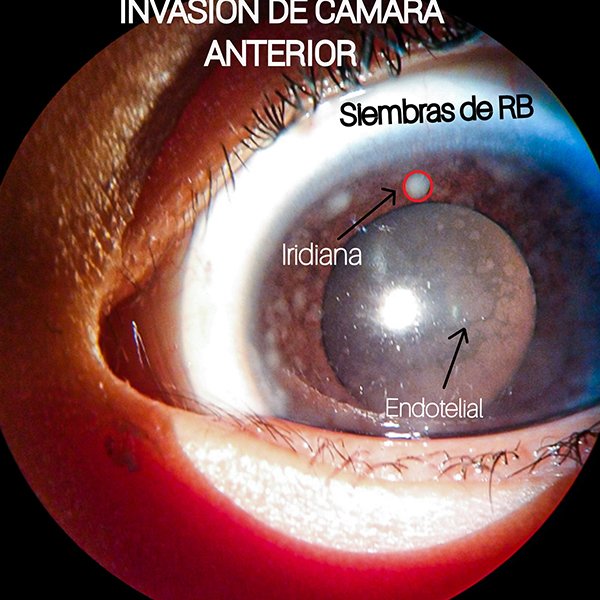 INVASIÓN DE CÁMARA ANTERIOR