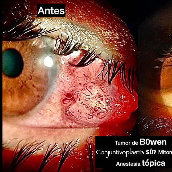 Tumor de Bowen