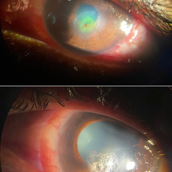Úlcera Corneal con Parche Cianocrilato