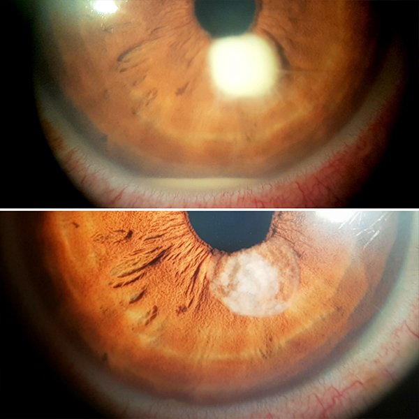 Absceso endogeno de iris
