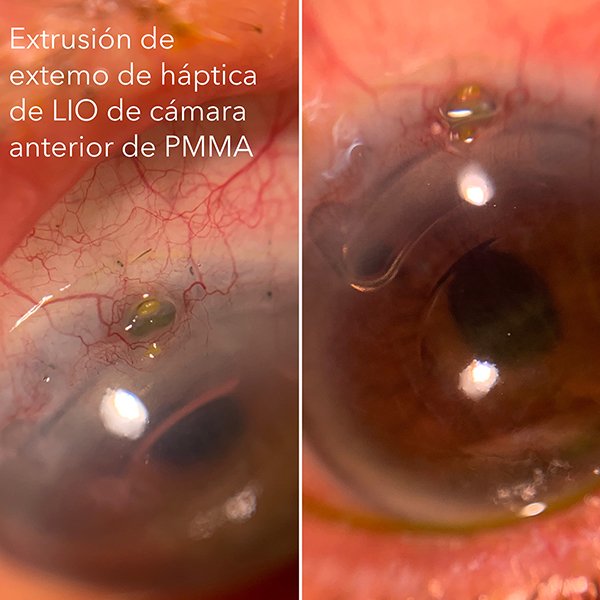 Extrusión LIO cámara anterior