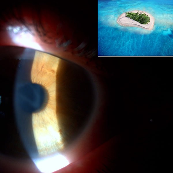 Cornea Island