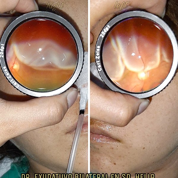 DR EXUDATIVO BILATERAL en SD. HELLP