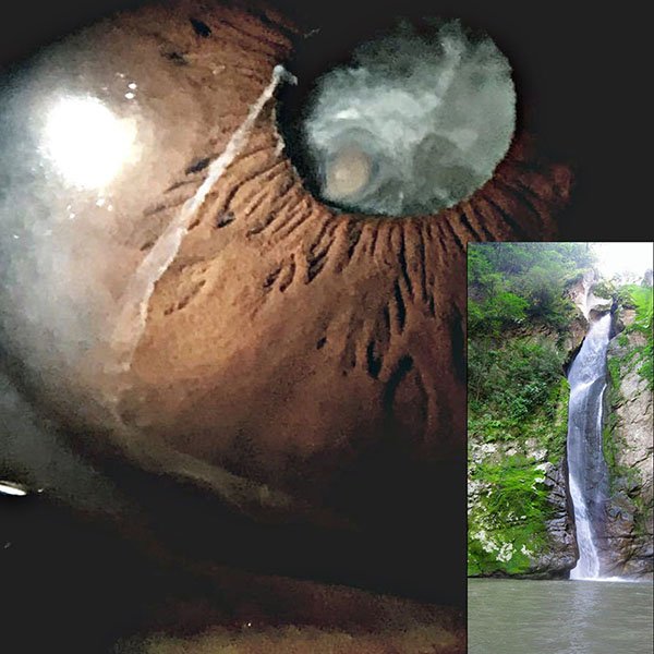 Catarata rubra con mucha pseudoexfoliacion