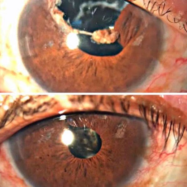 Sutura de iris