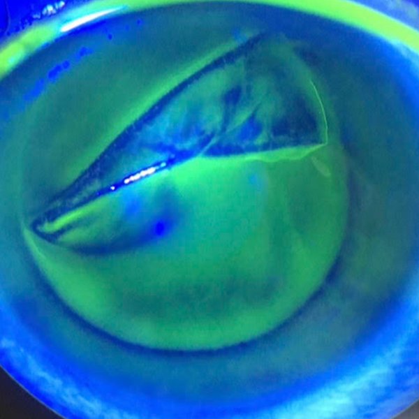 Dislocación traumática de flap corneal tras LASIK