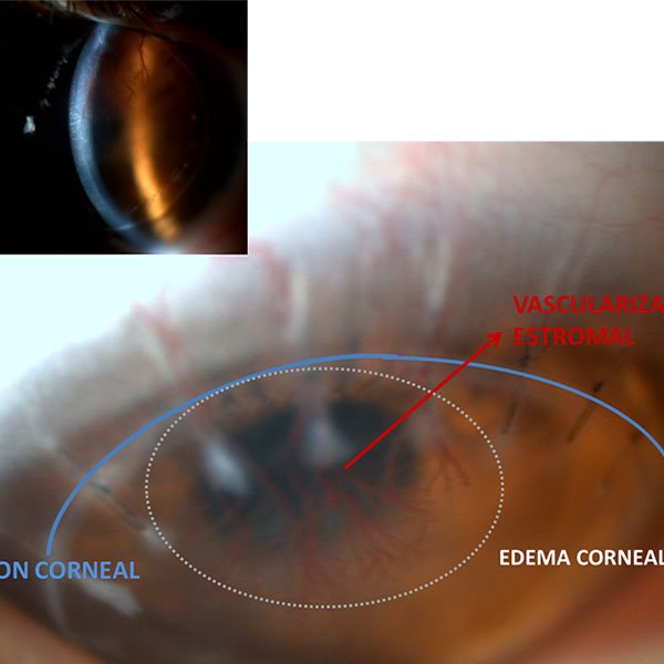 Rechazo estromal en queratoplastia lamelar