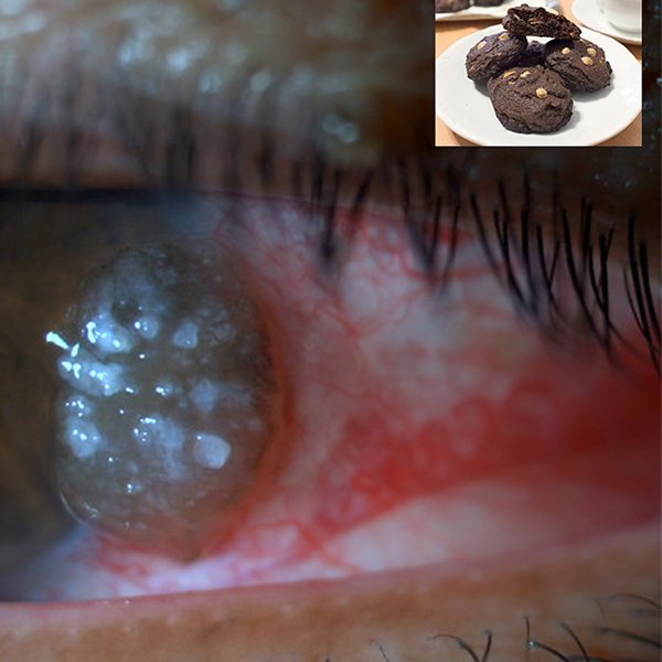 Neoplasia Intraepitelial Conjuntival