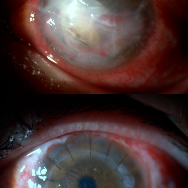 Queratoplastia reconstructiva