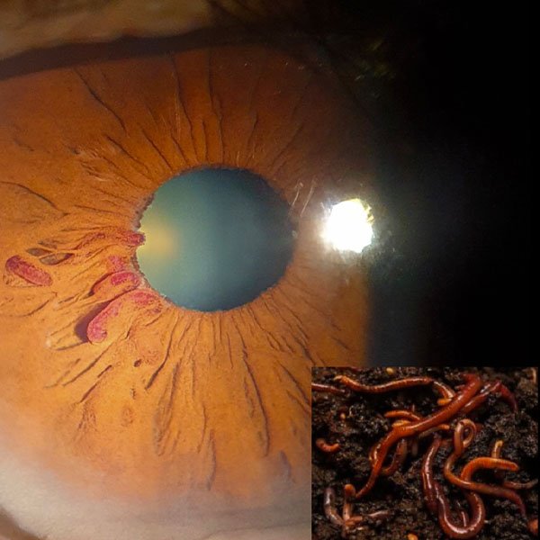 Hemangioma de Iris