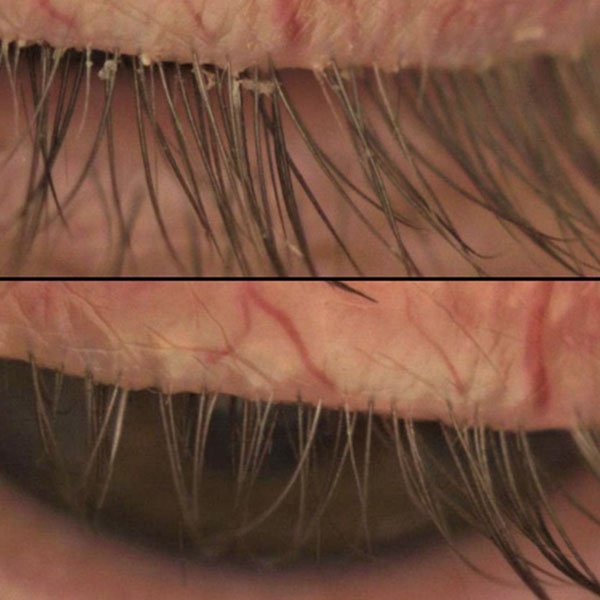 Sin collarete no hay Demodex