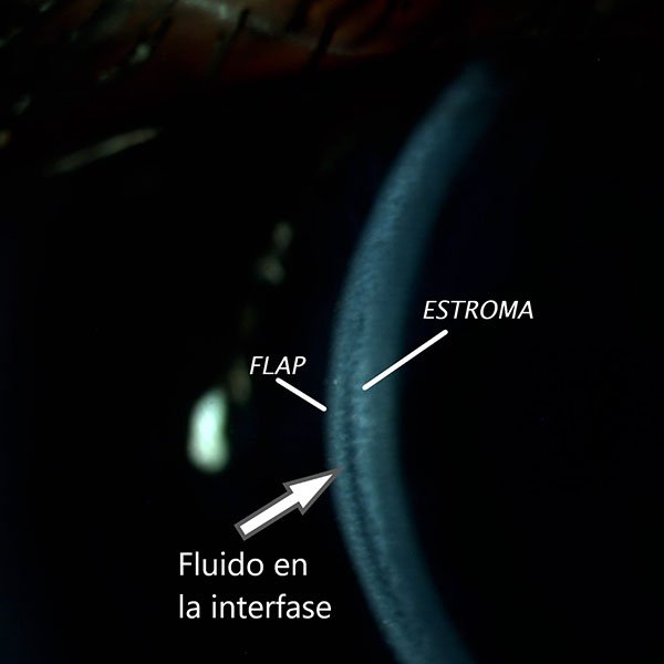 Síndrome de Fluido en la interfas