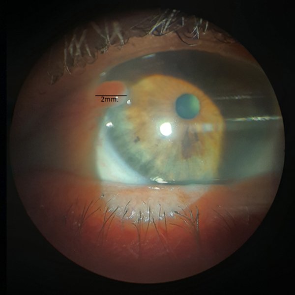 Granuloma en remisió