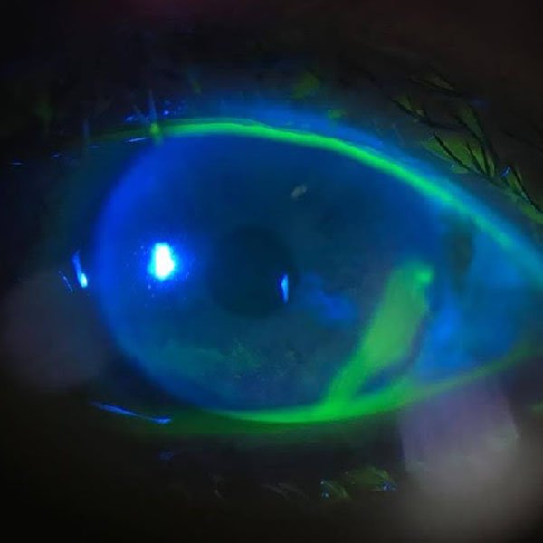 Corneal Ulcer