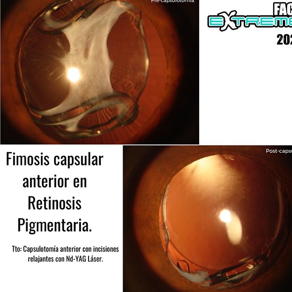 Fimosis Capsular Anterior en Retinosis Pigmentaria