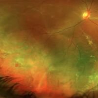 Retinal Detachment Surgery: Tips and Tricks Part 1