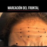 Step by Step para la Colocación de Botox