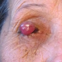 Tumor Palpebral Extremo