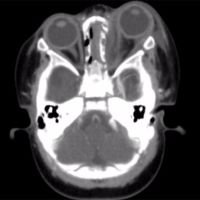 Absceso Subeperióstico en Neonato