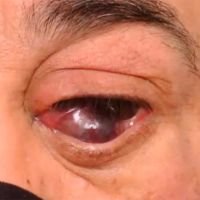 Melanoma Conjuntival