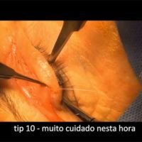 Blefaroplastia Estructurada