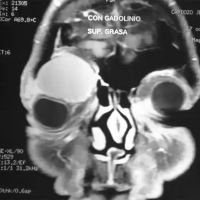 Tumor Orbitario Derecho