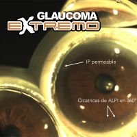 ALPI (Iridoplastia Periférica con Laser de Argón)