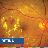 Evaluación del edema macular diabético