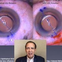 Manejo del Astigmatismo Residual Luego de Implantar LIO Tórico