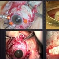 Retinal Detachment Surgery: Tips and Tricks Part 2