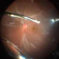 Manejo de desprendimiento de retina + agujero macular