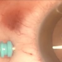 Catarata Traumática por herida penetrante corneal