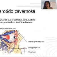 Fístula Carotida Cavernosa