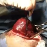 Exenteración Orbitaria Neonatal