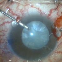 Catarata intumescente y Glaucoma